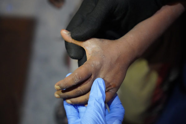 Paziente MSF affetto da scabbia in bangladesh